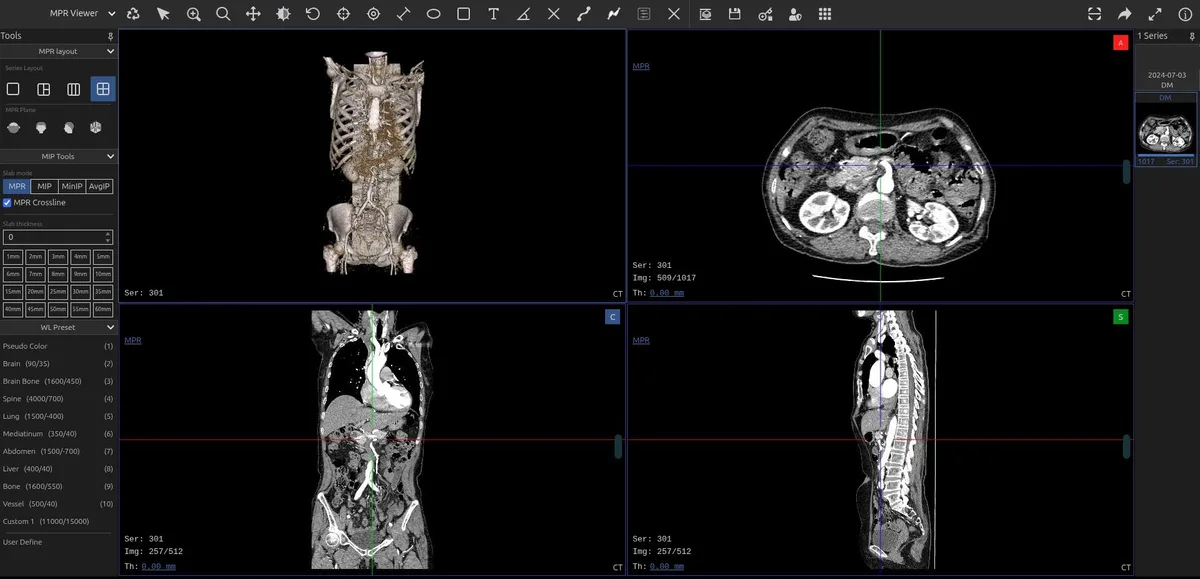 Giao diện saolaVIEW dựng đa mặt phẳng MPR và 3D trên ảnh CT